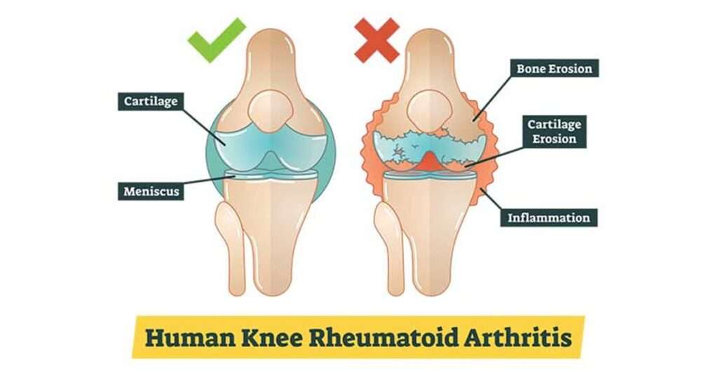 Rheumatoid Arthritis